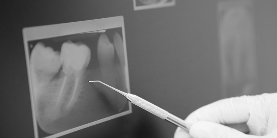 Endodonzia - Dott.ssa Rosita Pascale | RP Odontoiatria | Dentista Castel San Giovanni