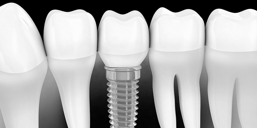 Implantologia - Dott.ssa Rosita Pascale | RP Odontoiatria | Dentista Castel San Giovanni